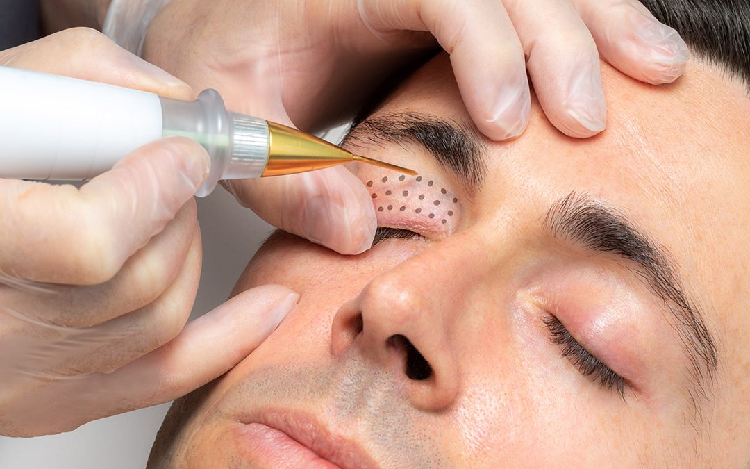 Rejuvenece con Plasma Pen fibroblast con ozono