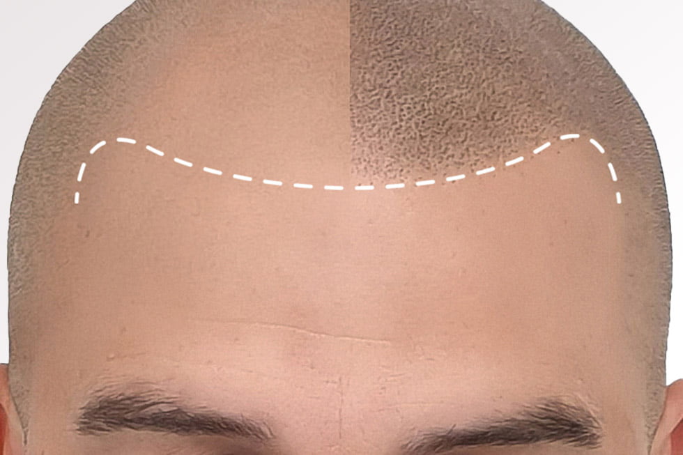 Micropigmentación Capilar o Tricopigmentación