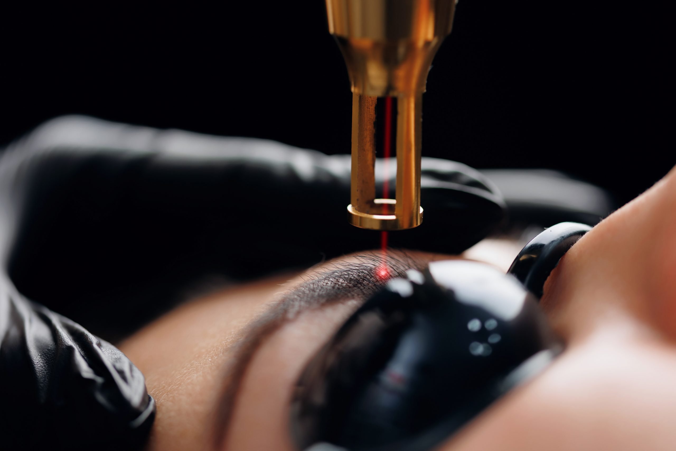 Eliminación Laser de Micropigmentación y Tatuaje