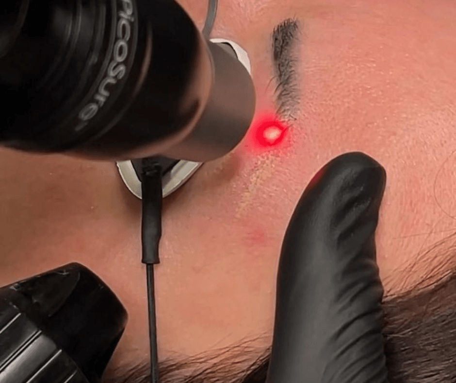 Eliminación Cejas Laser