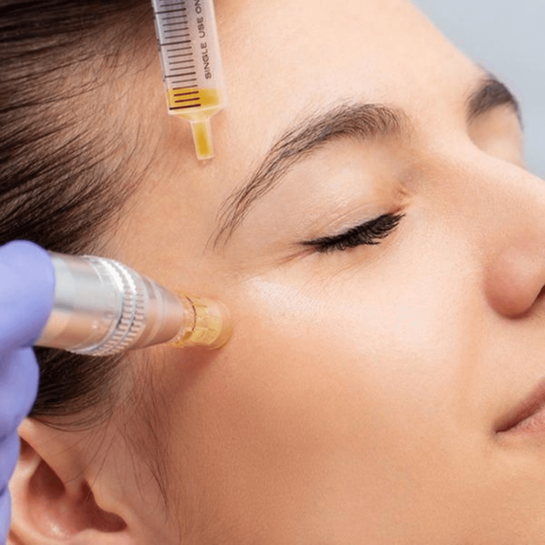 Vitaminas Faciales Dermapen y Microneedling