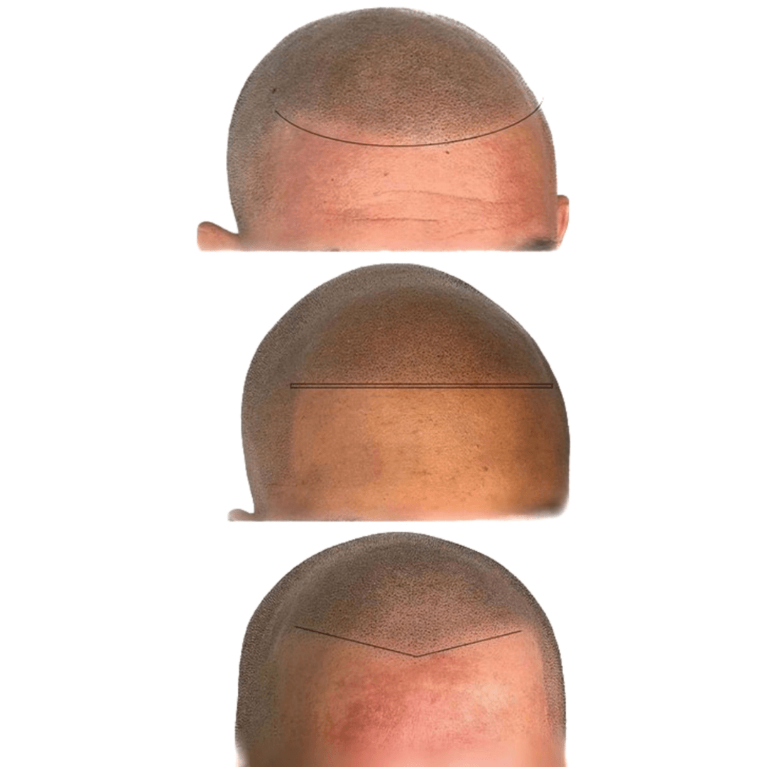 Micropigmentación Capilar o Tricopigmentacion