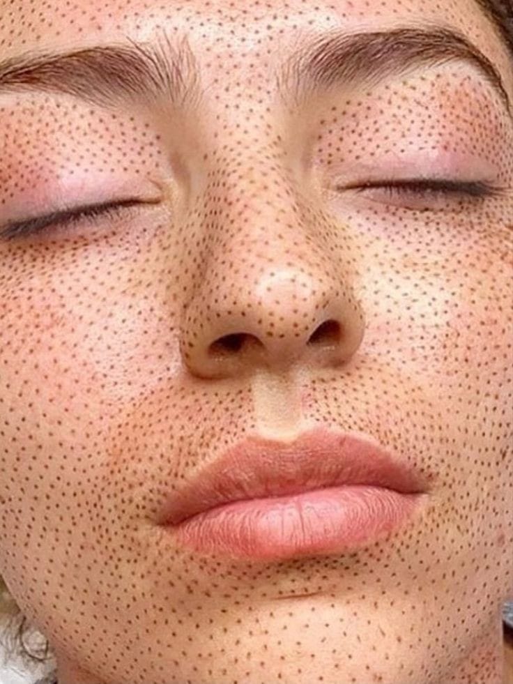 Plasma Pen Facial Completo