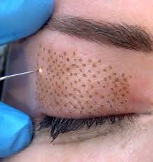 Plasma Pen Parpados Befaroplastia sin cirujia